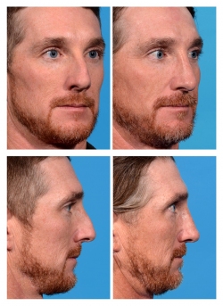 Male Rhinoplasty: Dorsal Hump, Airway Obstruction Male Rhinoplasty: Dorsal Hump, Airway Obstruction