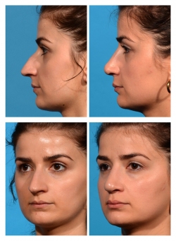 Rhinoplasty: Dorsal Hump, Droopy Tip